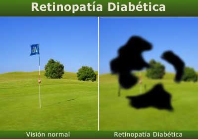 retinopatia[1]