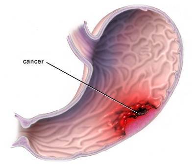 Cancer-de-estomago