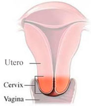 cancer_cuello