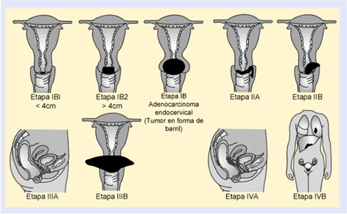 estadios_papiloma_mujeres