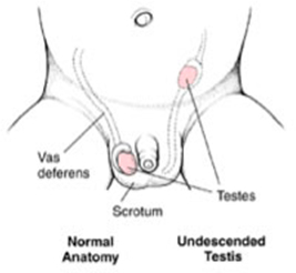 cancer_testiculos