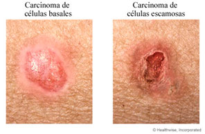 carcinoma