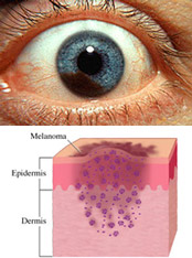 melanoma_ocular