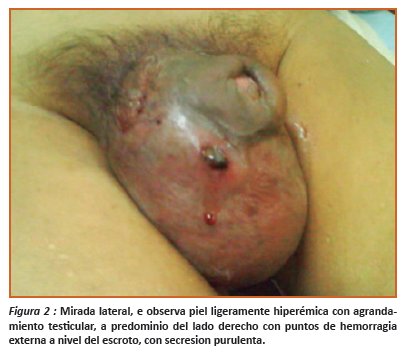 seminoma