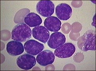 leucemia_ aguda