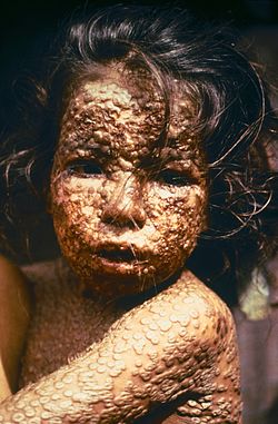250px-Child_with_Smallpox_Bangladesh