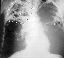 220px-Tuberculosis-x-ray-1