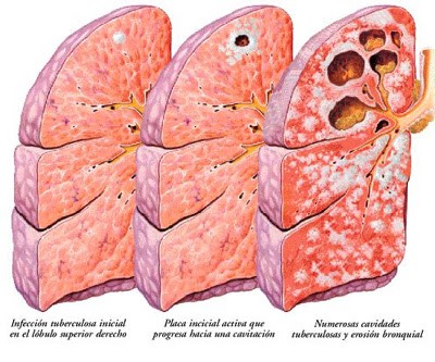 infeccionalveolar