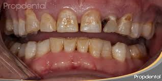 fluorosis2