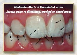 fluorosis3