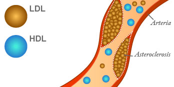 ldl-hdl