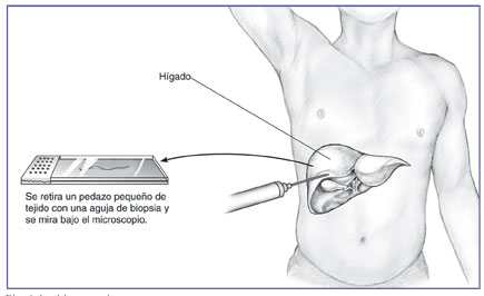 BiopsyNeedle_SP