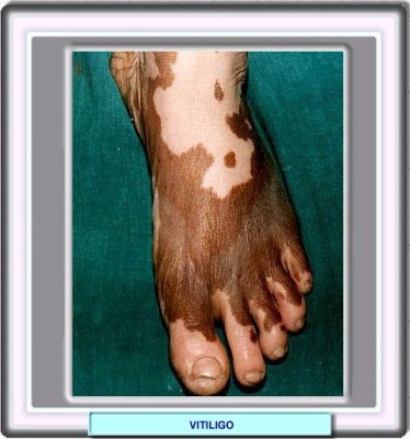 vitiligo07