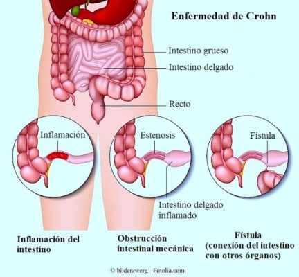 Crohn