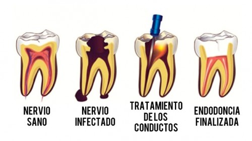 endodoncia