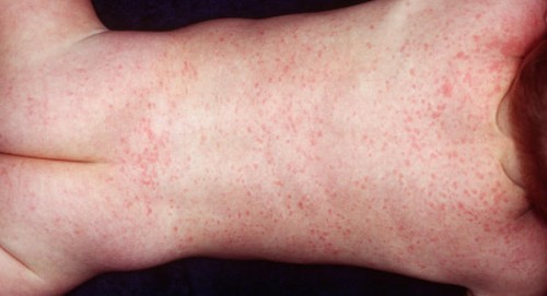 roseola