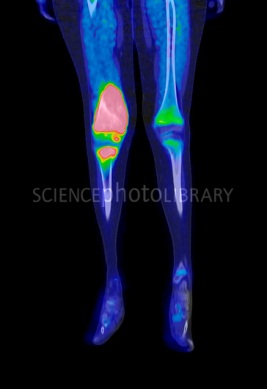 Pet Scan