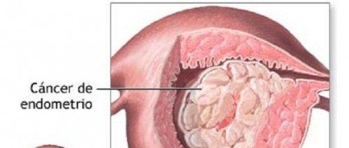 ca endometrio