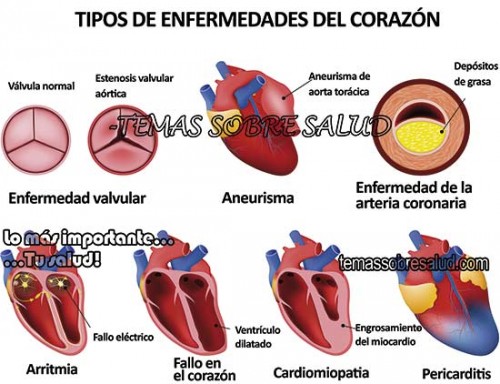 tipos de cardiop